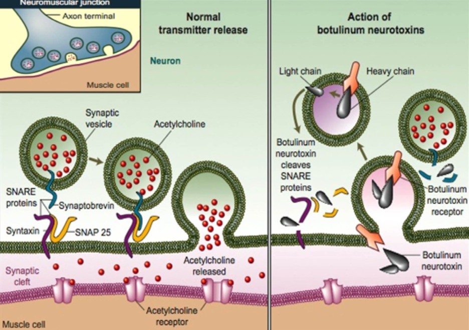 Botulinum-Neurotoxin