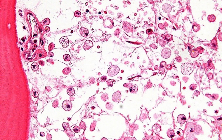 리소좀축적병(Lysosomal Storage Disease, LSD), 희귀질환 선별검사로 진단