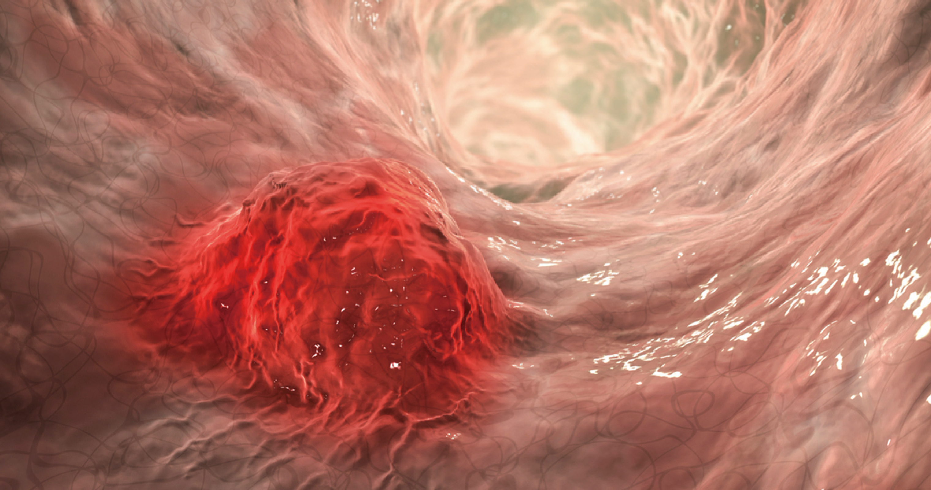 미세잔존질환(Minimal Residual Disease, MRD)  검출을 위한 유세포검사(Flow Cytometry)