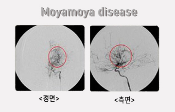 뇌혈관 좁아지는 '모야모야병'… 매년 1000명씩 증가